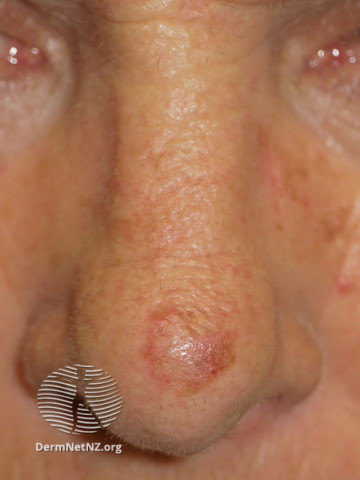 File:Actinic keratoses on the nose (DermNet NZ lesions-sks-nose5).jpg
