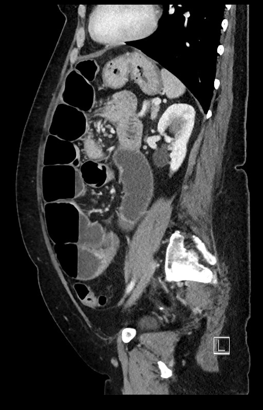 Active Crohn disease (Radiopaedia 59394-66750 Sagittal C+ portal venous phase 20).jpg