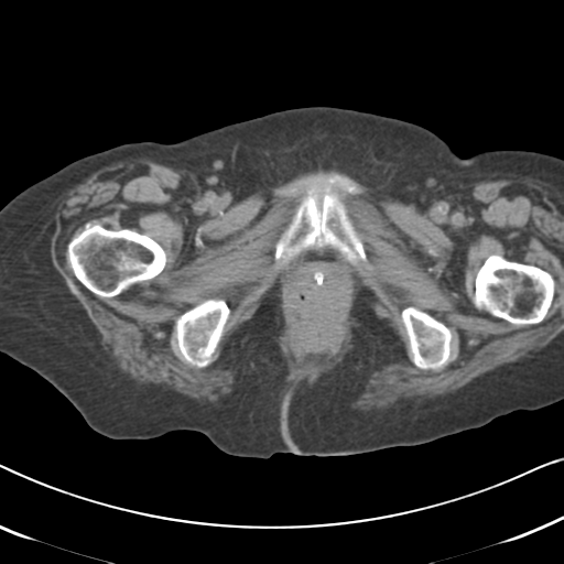 File:Active bleeding from duodenal ulcer with embolization (Radiopaedia 34216-35481 Axial non-contrast 72).png