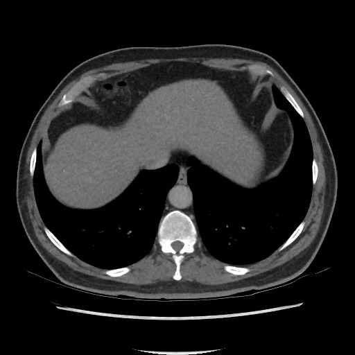 File:Active colonic bleed on CT (Radiopaedia 49765-55025 Axial C+ delayed 11).jpg