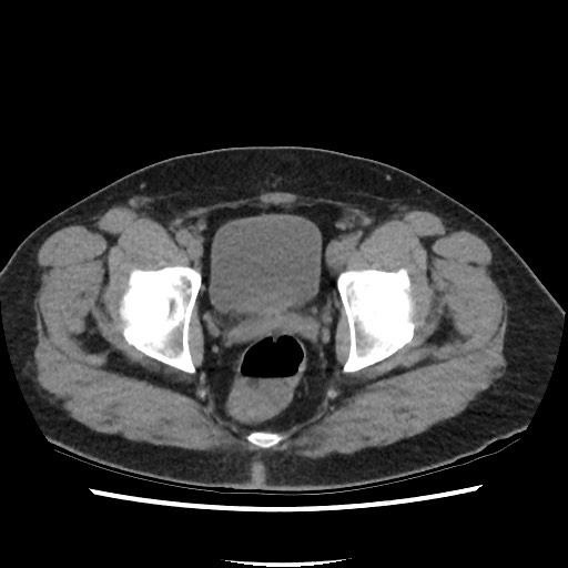 Active colonic bleed on CT (Radiopaedia 49765-55025 Axial non-contrast 77).jpg