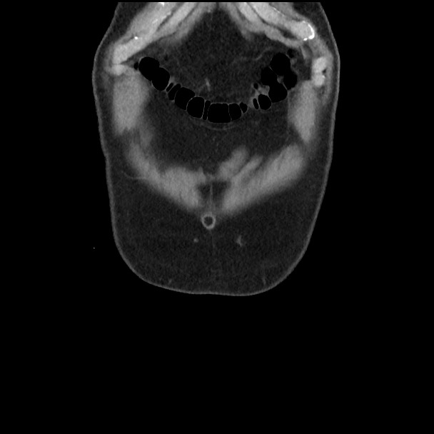 Active colonic bleed on CT (Radiopaedia 49765-55025 Coronal non-contrast 8).jpg