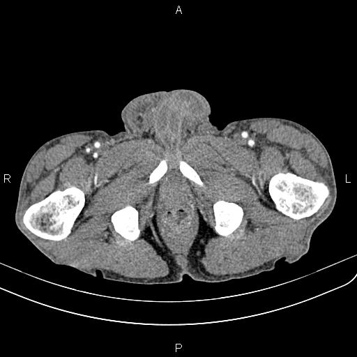Active crohn disease (Radiopaedia 87133-103397 Axial C+ arterial phase 108).jpg