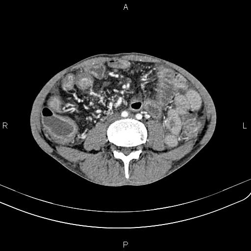 Active crohn disease (Radiopaedia 87133-103397 Axial C+ arterial phase 61).jpg