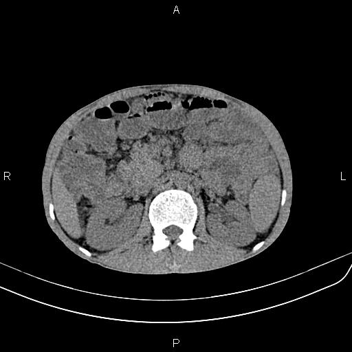 File:Active crohn disease (Radiopaedia 87133-103397 Axial non-contrast 39).jpg