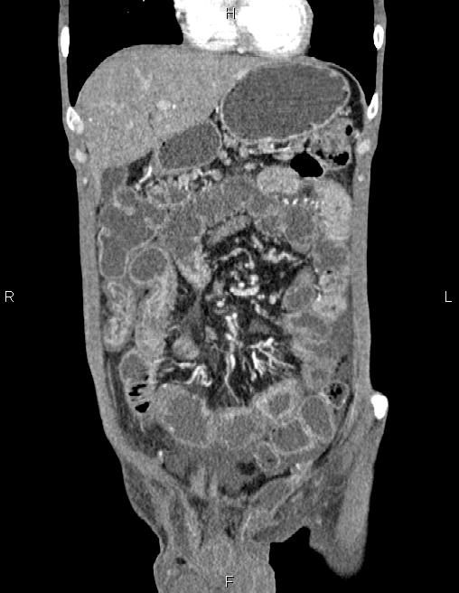 Active crohn disease (Radiopaedia 87133-103397 Coronal C+ arterial phase 15).jpg