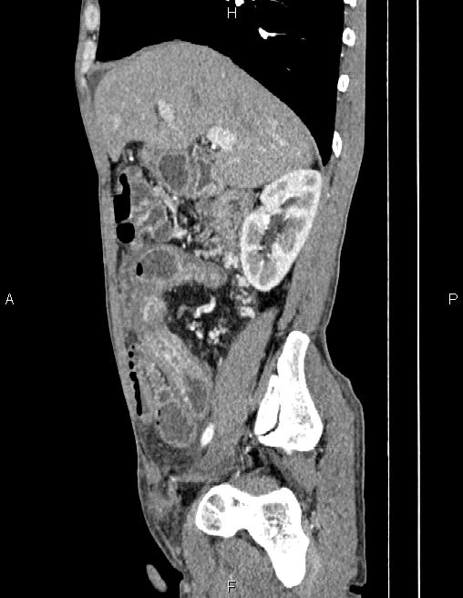 Active crohn disease (Radiopaedia 87133-103397 Sagittal C+ arterial phase 27).jpg