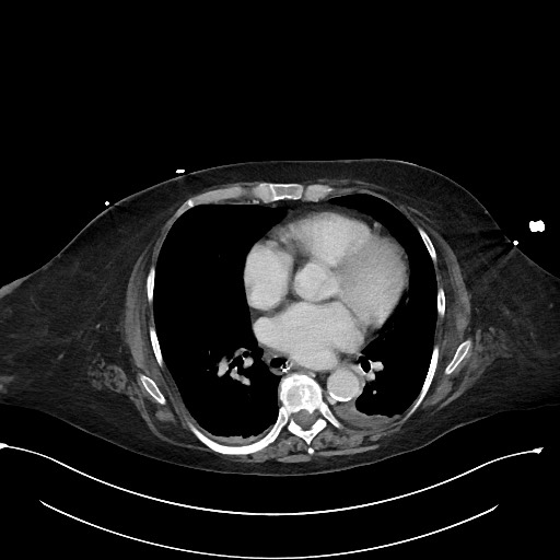 File:Active renal extravasation with large subcapsular and retroperitoneal hemorrhage (Radiopaedia 60975-68796 Axial 369).jpg