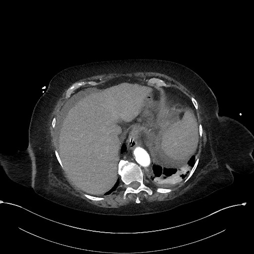 File:Active renal extravasation with large subcapsular and retroperitoneal hemorrhage (Radiopaedia 60975-68796 Axial C+ arterial phase 34).jpg