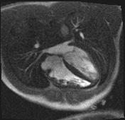 Active right ventricular cardiac sarcoidosis (Radiopaedia 55596-62100 Axial Dynamic perfusion scan MOCO 62).jpg