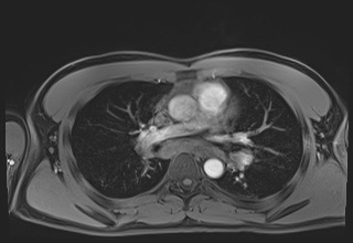 File:Active right ventricular cardiac sarcoidosis (Radiopaedia 55596-62100 Axial Post contrast Dixon 29).jpg