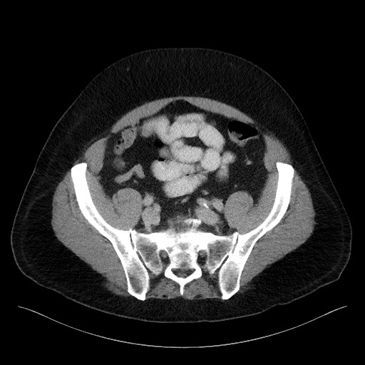 Acute-on-chronic pancreatitis (Radiopaedia 67286-76656 Axial C+ portal venous phase 61).jpg