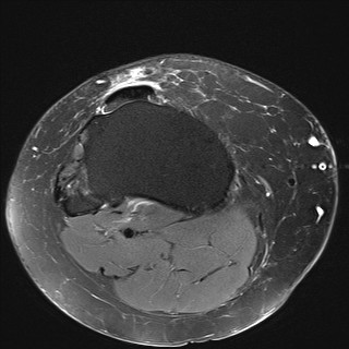 File:Acute-on-chronic transient lateral patellar dislocation with trochlear dysplasia (Radiopaedia 84099-99349 Axial PD fat sat 30).jpg