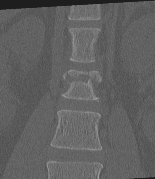 File:Acute L1 burst compression fracture (Radiopaedia 34430-35755 Coronal bone window 15).png