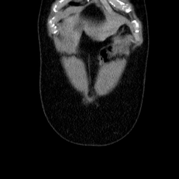 Acute appendicitis (Radiopaedia 38255-40270 Coronal C+ portal venous phase 13).jpg