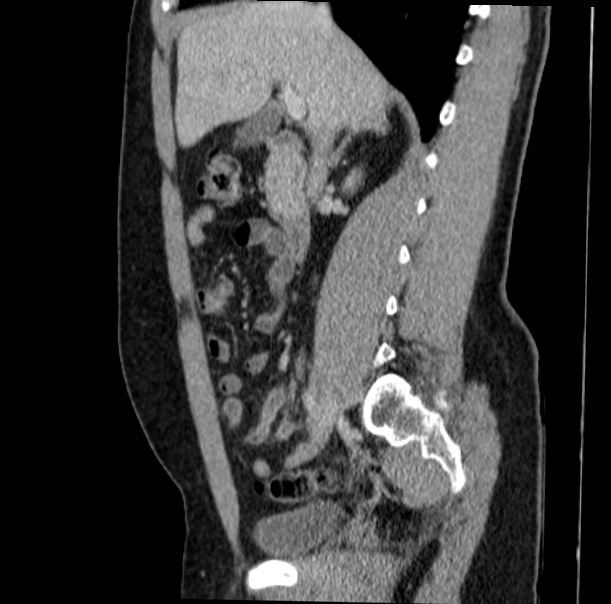 Acute appendicitis (Radiopaedia 38255-40270 Sagittal C+ portal venous phase 34).jpg