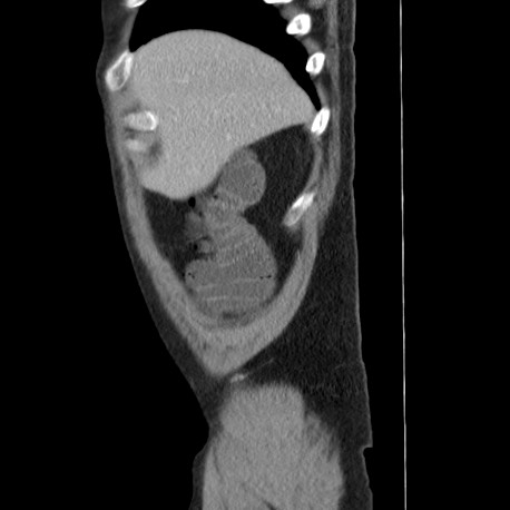 Acute appendicitis (Radiopaedia 66513-75790 Sagittal C+ portal venous phase 11).jpg
