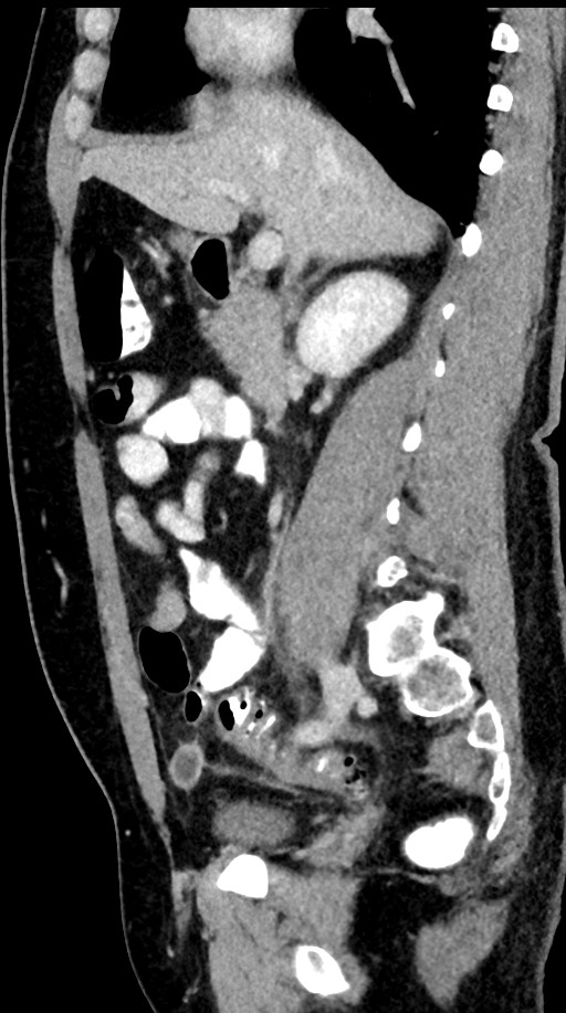 Acute appendicitis (Radiopaedia 77016-88960 Sagittal C+ portal venous phase 70).jpg