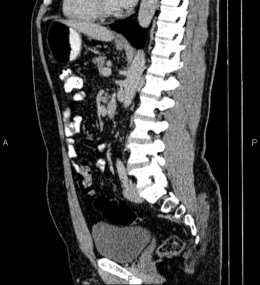 Acute appendicitis (Radiopaedia 84780-100240 Sagittal C+ portal venous phase 59).jpg