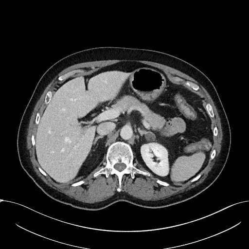 File:Acute appendicitis - large appendicoliths (Radiopaedia 61805-69820 Axial C+ portal venous phase 36).jpg