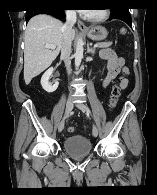 Acute appendicitis - large appendicoliths (Radiopaedia 61805-69820 Coronal C+ portal venous phase 71).jpg
