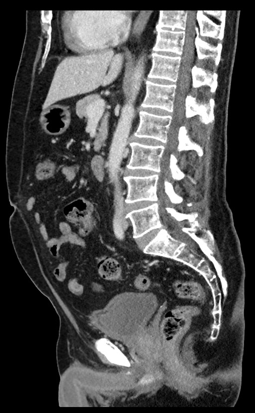 Acute appendicitis - large appendicoliths (Radiopaedia 61805-69820 Sagittal C+ portal venous phase 59).jpg