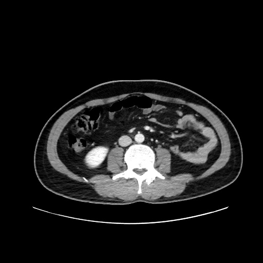 Acute appendicitis and COVID 19 pneumonia (Radiopaedia 76604-88380 Axial C+ portal venous phase 43).jpg