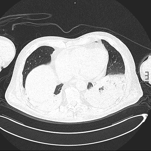 Acute aspiration pneumonitis (Radiopaedia 55642-62166 Axial lung window 115).jpg