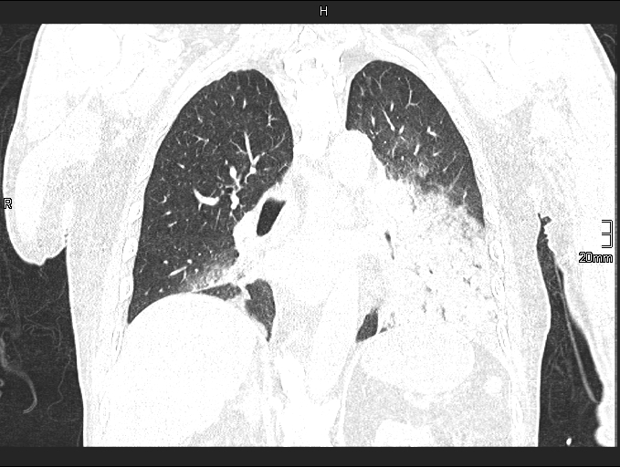 File:Acute aspiration pneumonitis (Radiopaedia 55642-62166 Coronal lung window 64).jpg