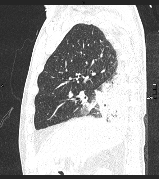 File:Acute aspiration pneumonitis (Radiopaedia 55642-62166 Sagittal lung window 106).jpg