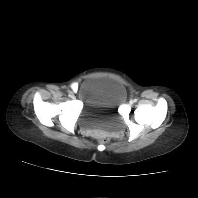Acute calculous cholecystitis in patient with osteopetrosis (Radiopaedia 77871-90159 Axial C+ portal venous phase 75).jpg