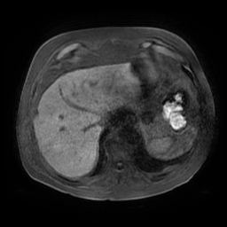 File:Acute cholecystitis complicated by pylephlebitis (Radiopaedia 65782-74915 Axial T1 fat sat 16).jpg