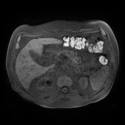 Acute cholecystitis complicated by pylephlebitis (Radiopaedia 65782-74915 Axial T1 fat sat 52).jpg