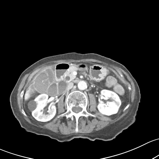 File:Acute cholecystitis with contained perforation (Radiopaedia 47328-51907 Axial C+ portal venous phase 30).png