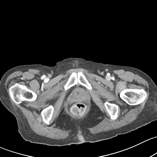 Acute cholecystitis with contained perforation (Radiopaedia 47328-51907 Axial C+ portal venous phase 75).png