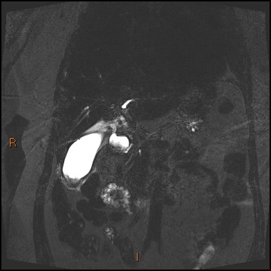 File:Acute cholecystitis with gallbladder neck calculus (Radiopaedia 42795-45971 Coronal Turbo spin echo 29).jpg