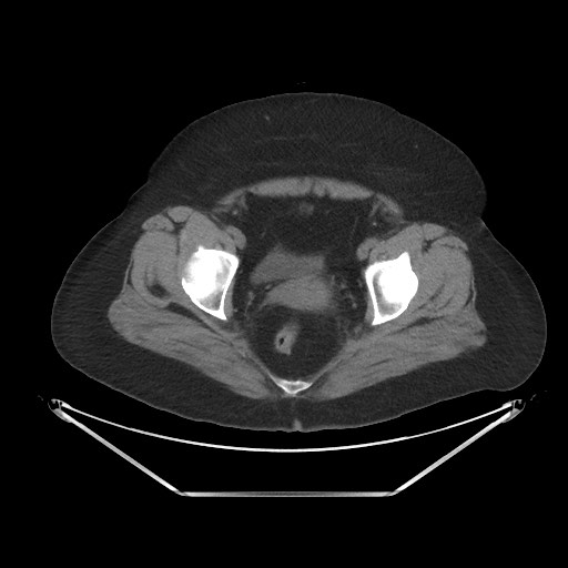 File:Acute cholecystitis with tensile fundus sign (Radiopaedia 71394-81723 Axial non-contrast 107).jpg