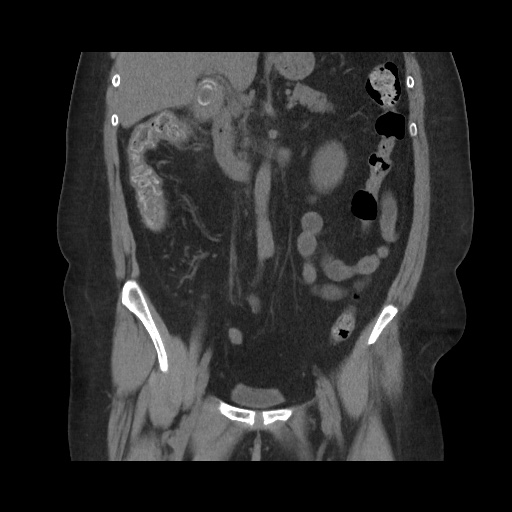 File:Acute cholecystitis with tensile fundus sign (Radiopaedia 71394-81723 Coronal non-contrast 65).jpg