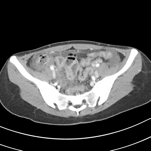 Acute gangrenous appendicitis with perforation (Radiopaedia 40152-42662 Axial C+ portal venous phase 57).png