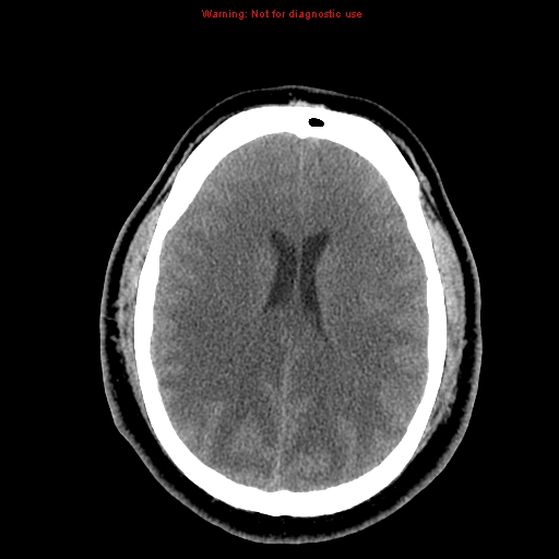 Acute hemorrhagic leukoencephalitis (Radiopaedia 14076-13920 Axial non-contrast 31).jpg