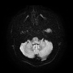 Acute internal carotid artery dissection (Radiopaedia 53541-59632 Axial DWI 7).jpg