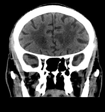 Acute left anterior cerebral artery territory infarction (Radiopaedia 51785-57578 Coronal non-contrast 19).jpg