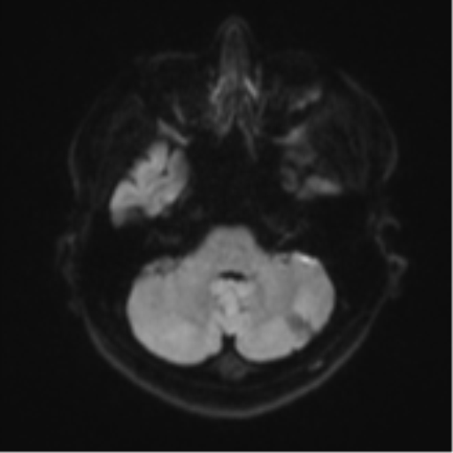 Acute left middle cerebral artery territory infarct with clot retrieval (Radiopaedia 47732-52433 Axial DWI 37).png