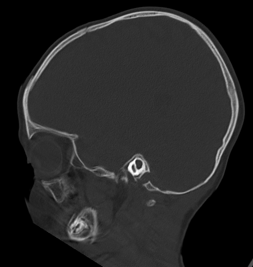 Acute mastoiditis (Radiopaedia 82678-96881 Sagittal bone window 45).jpg