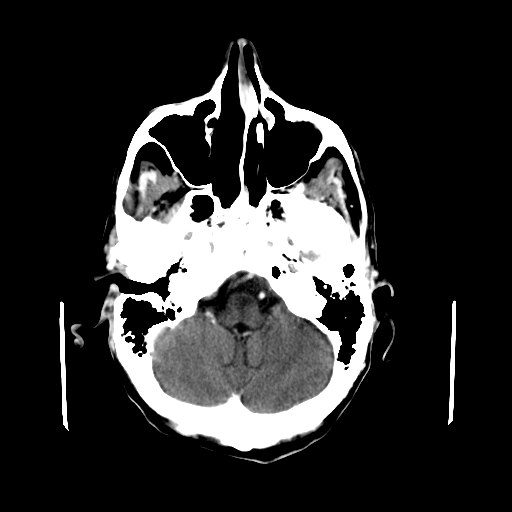 File:Acute necrotizing toxoplasma encephalitis (Radiopaedia 10683-11150 C+ arterial phase 26).jpg