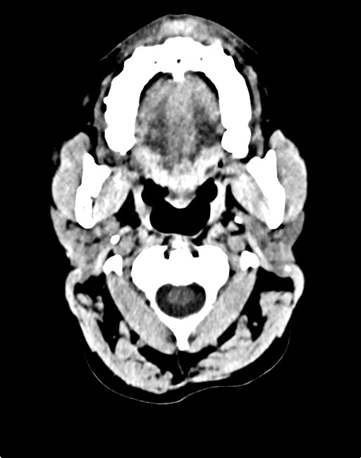 Acute on chronic subdural hematoma (Radiopaedia 74814-85823 Axial non-contrast 18).jpg