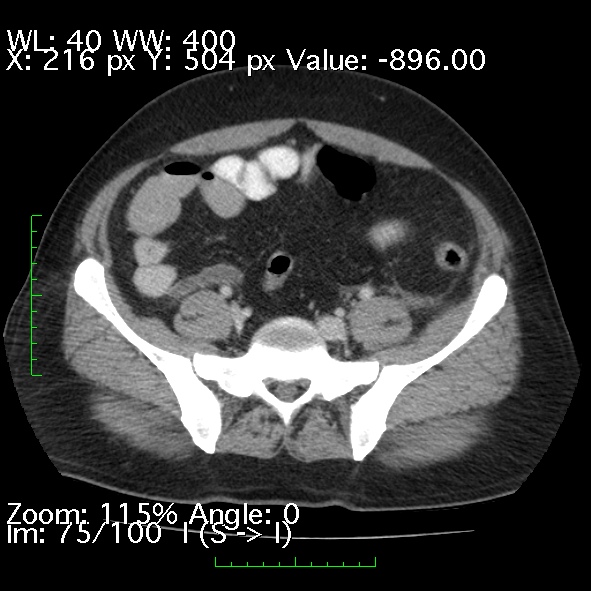 Acute pancreatitis (Radiopaedia 34043-35276 Axial C+ portal venous phase 75).jpg