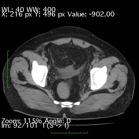 Acute pancreatitis (Radiopaedia 34043-35276 Axial non-contrast 92).jpg