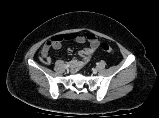 File:Acute pancreatitis (Radiopaedia 69236-79012 Axial C+ portal venous phase 69).jpg
