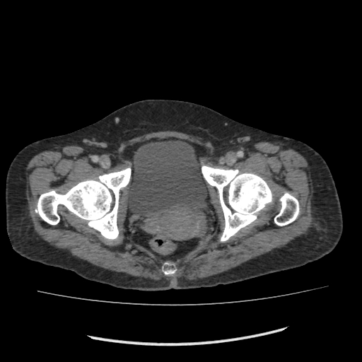 Acute pancreatitis (Radiopaedia 80007-93285 Axial C+ portal venous phase 122).jpg